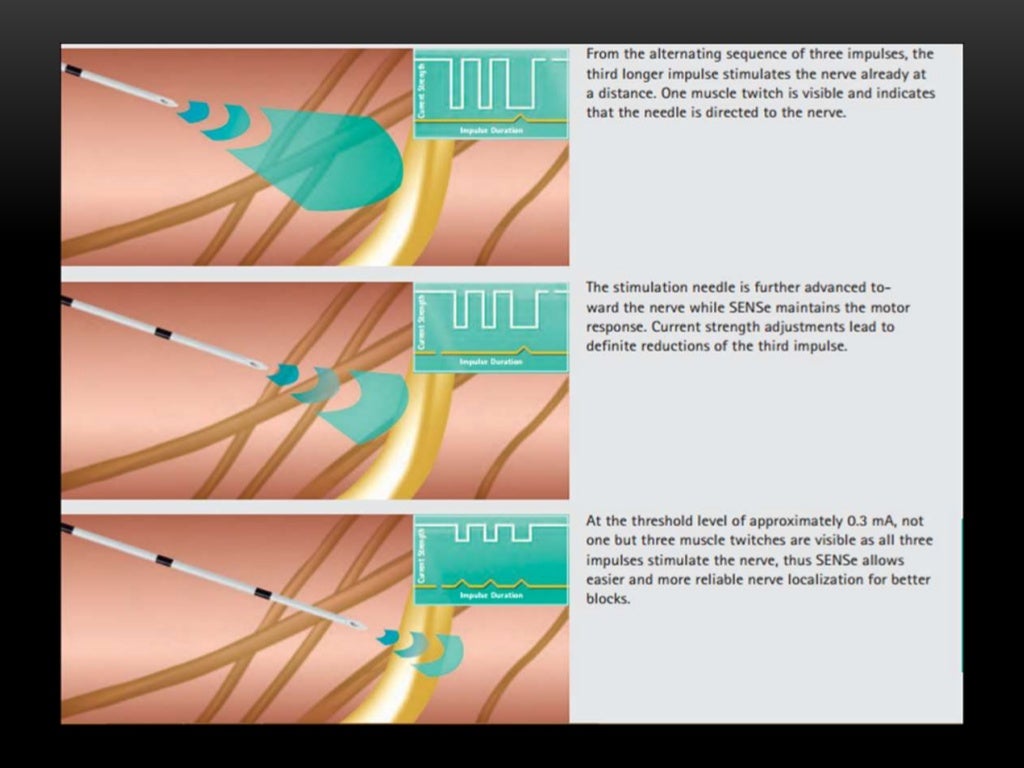 Basics of peripheral nerve stimulation