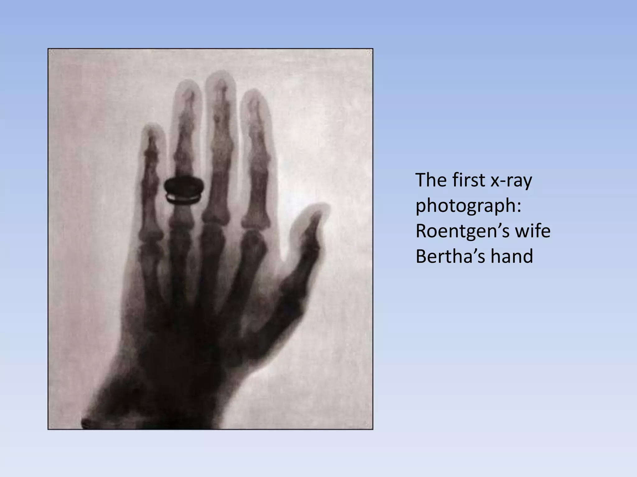 The first x-ray
photograph:
Roentgen’s wife
Bertha’s hand

 
