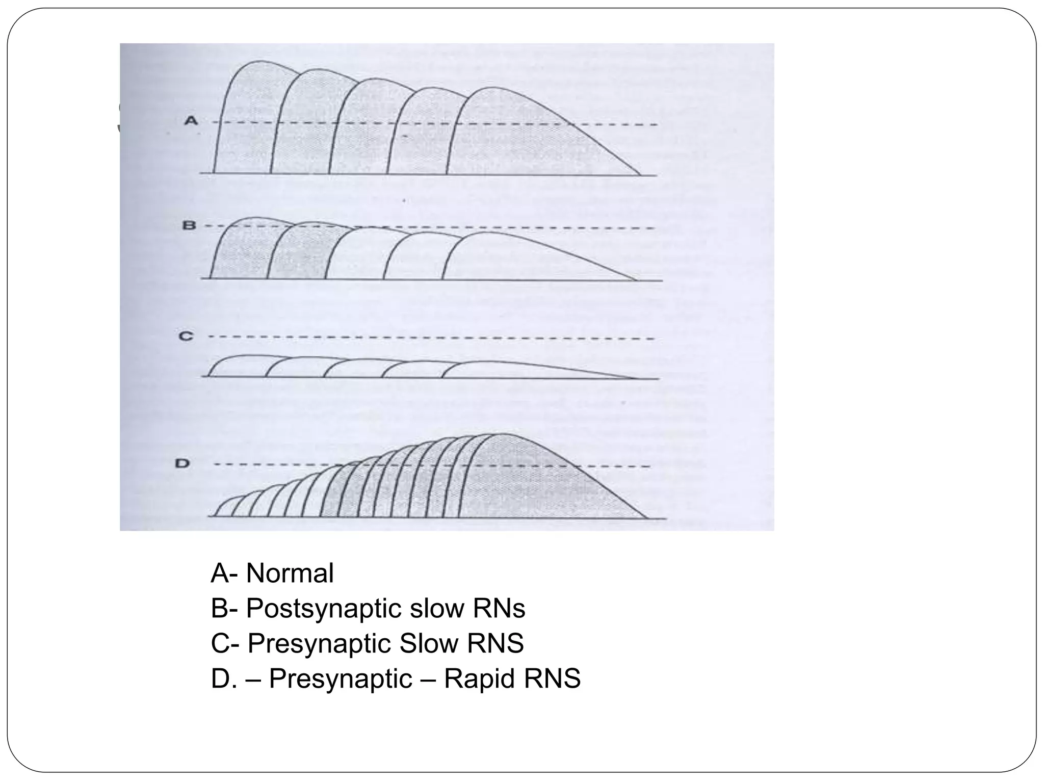 S
A- Normal
B- Postsynaptic slow RNs
C- Presynaptic Slow RNS
D. – Presynaptic – Rapid RNS
 