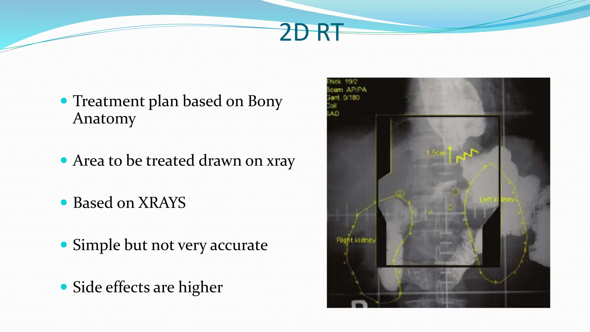 BASICS OF RADIATION THERAPY/RADIATION ONCOLOGY | PPTX