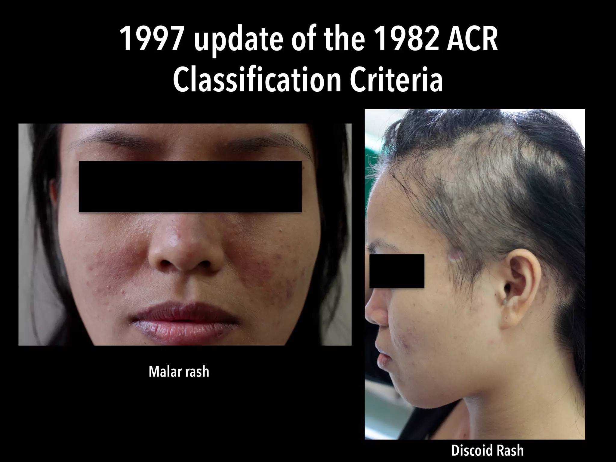 1997 update of the 1982 ACR
Classiﬁcation Criteria
Malar rash
Discoid Rash
 