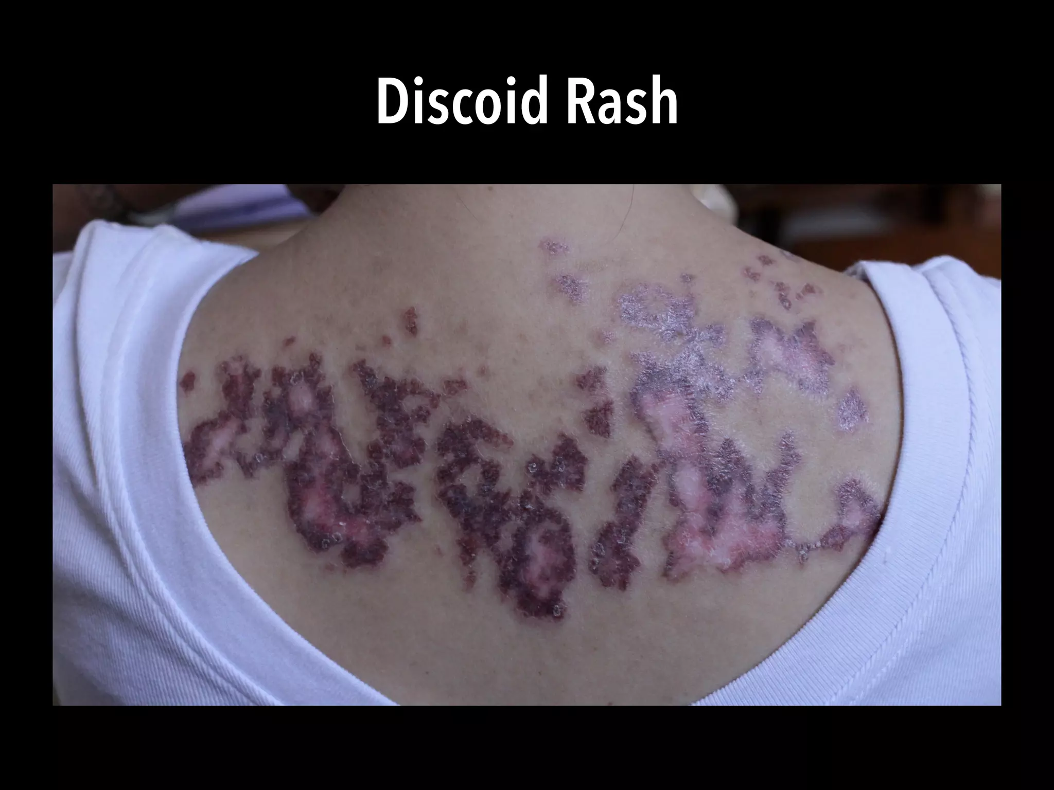 Discoid Rash
 