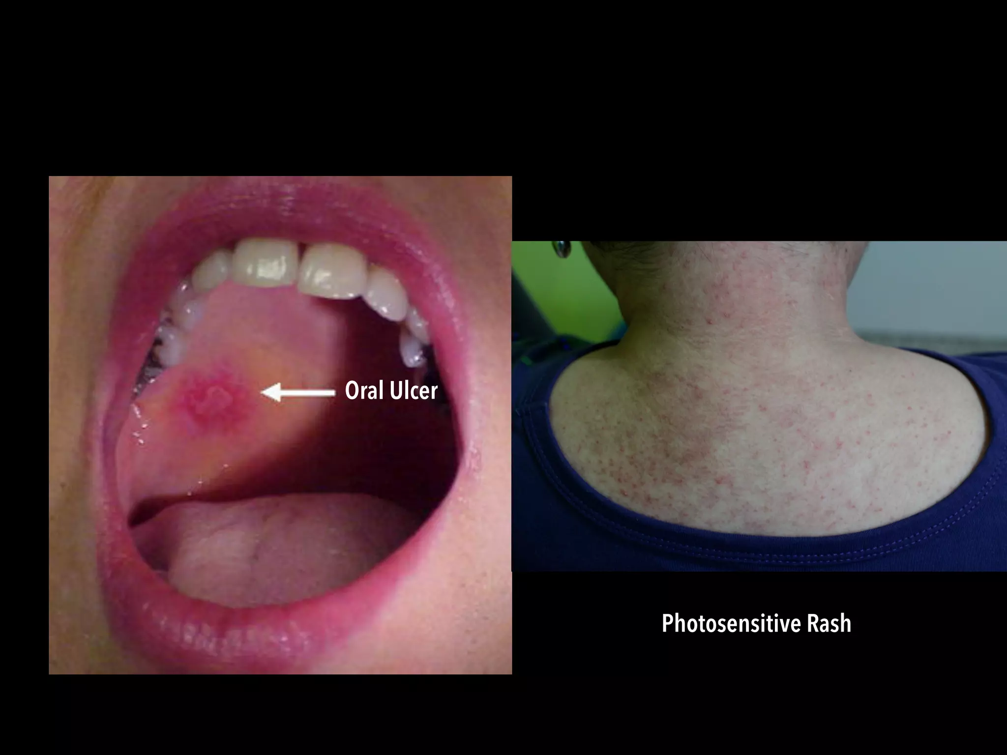 Oral Ulcer
Photosensitive Rash
 