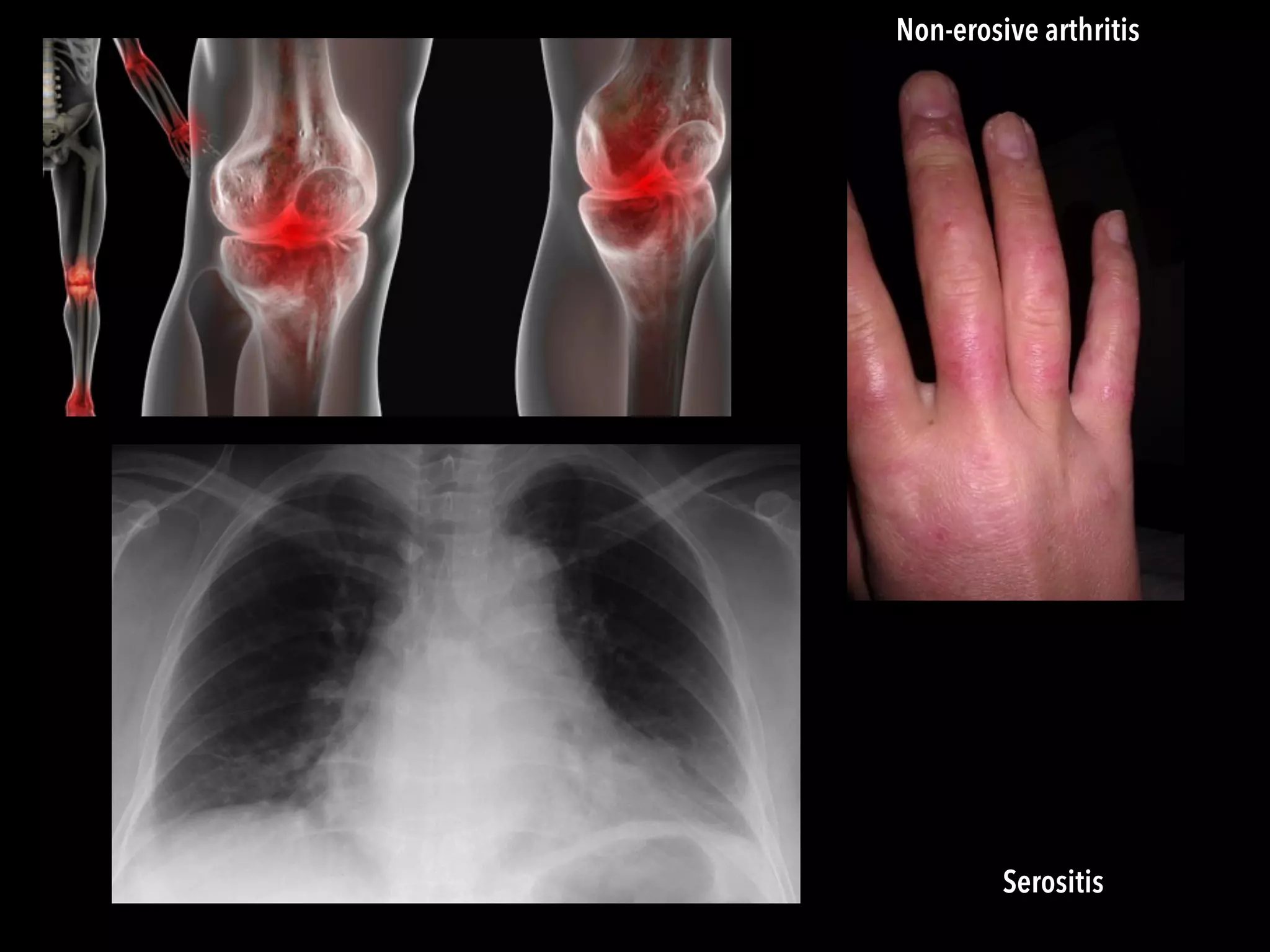 Serositis
Non-erosive arthritis
 