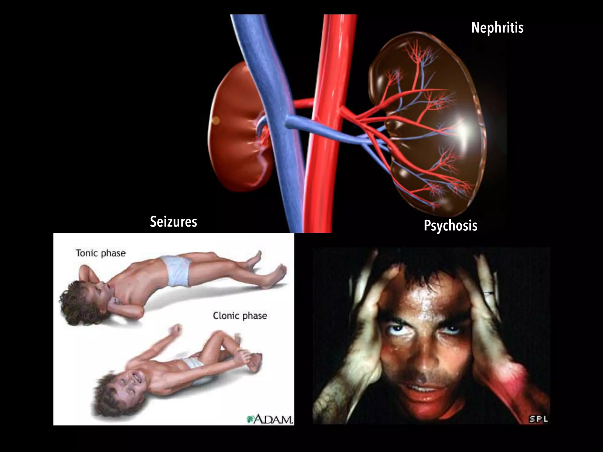 Nephritis
Seizures Psychosis
 