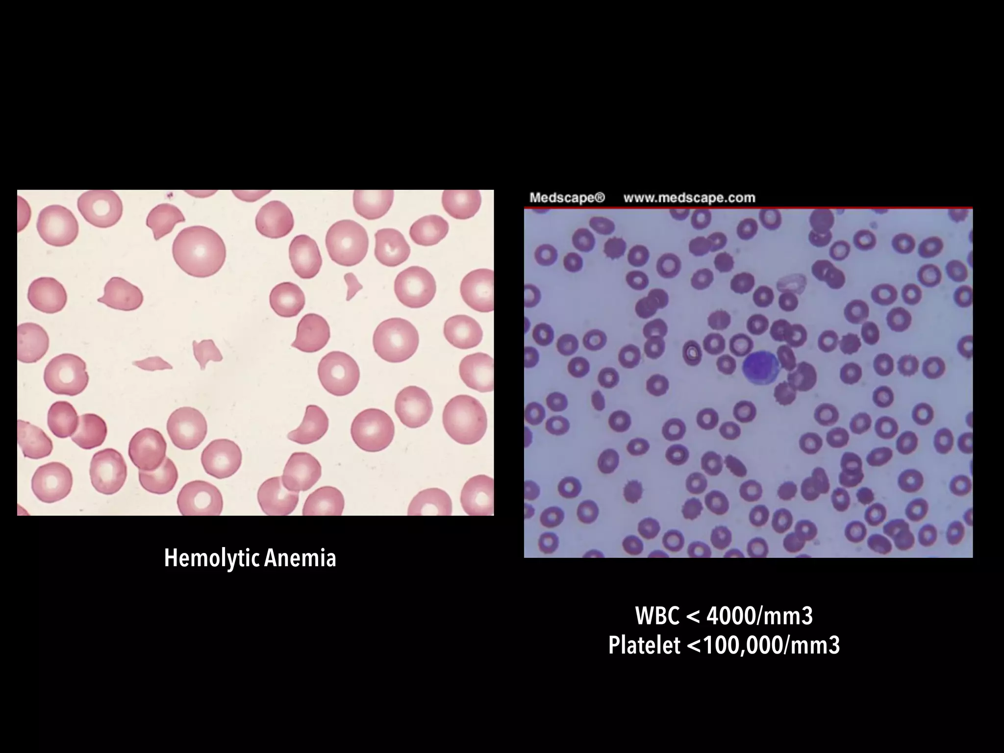 WBC < 4000/mm3
Platelet <100,000/mm3
Hemolytic Anemia
 