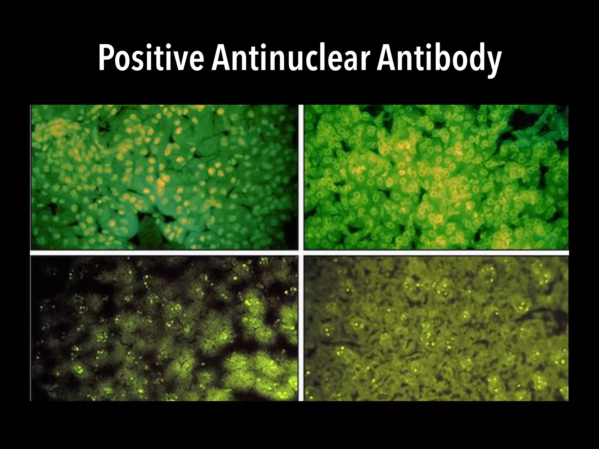 Positive Antinuclear Antibody
 