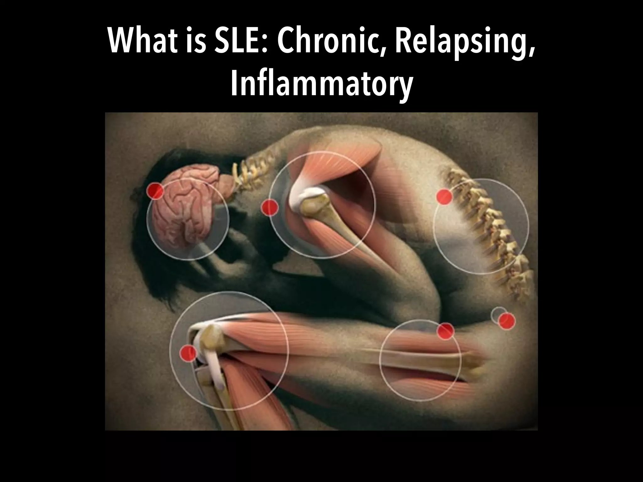 What is SLE: Chronic, Relapsing,
Inﬂammatory
 