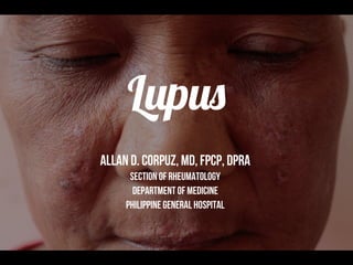 Lupus
Allan D. Corpuz, MD, FPCP, DPRA
Section of Rheumatology
Department of Medicine
Philippine GENERAL HOSPITAL
 