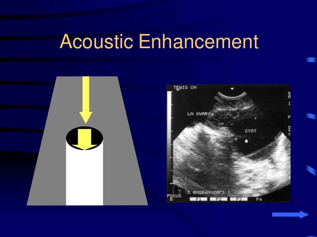Basics of Chest Sonography and Anatomy of Chest Wall