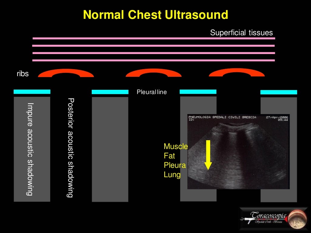 Basics of Chest Sonography and Anatomy of Chest Wall