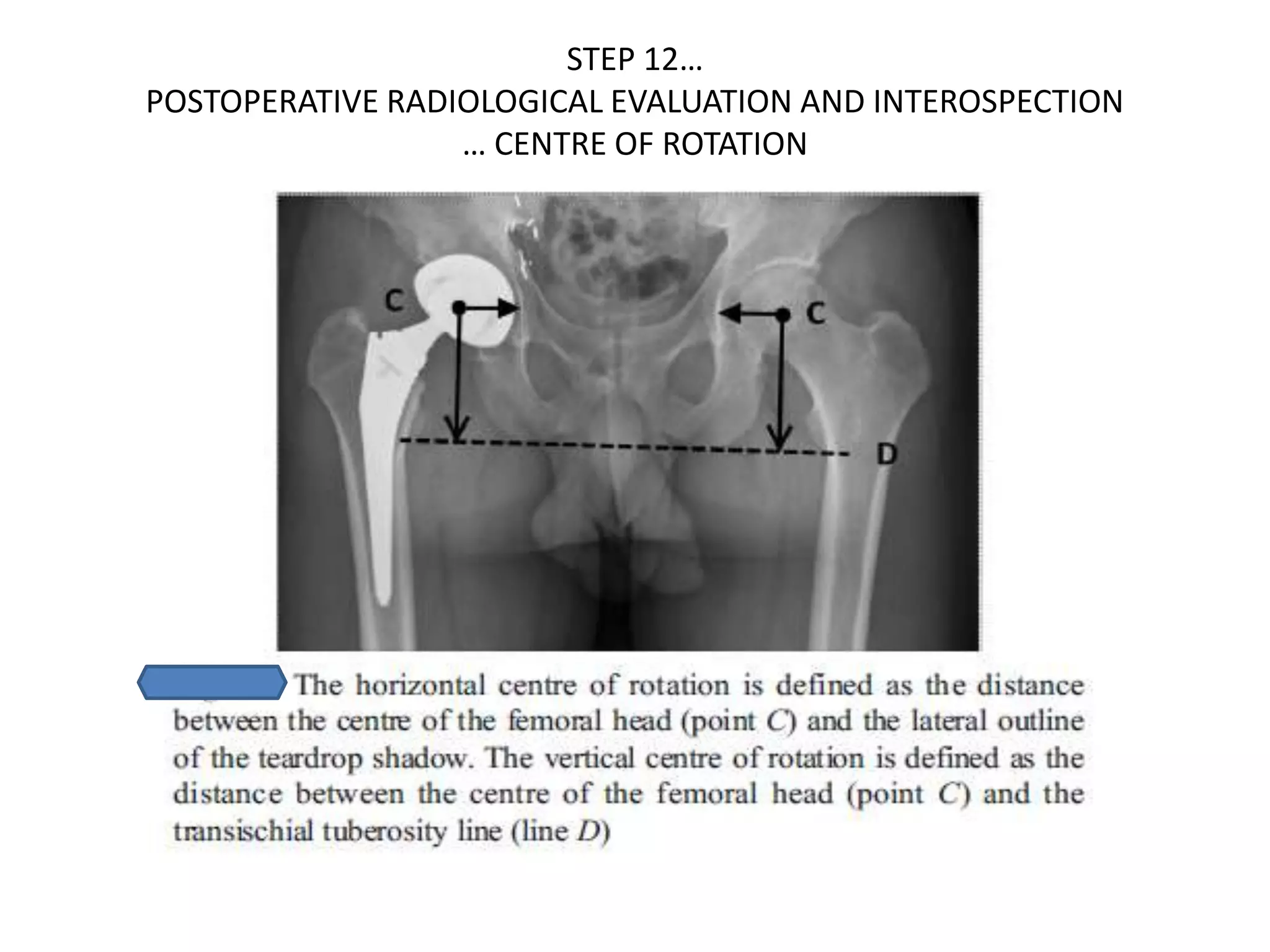 Basics of total hip replacement by DR. D. P. SWAMI | PPTX