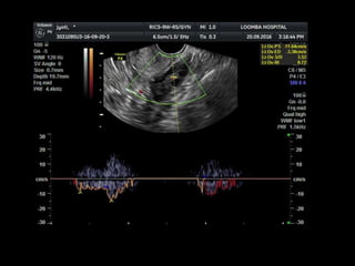 Color Doppler Roku Basics of tvs color doppler | PPTX