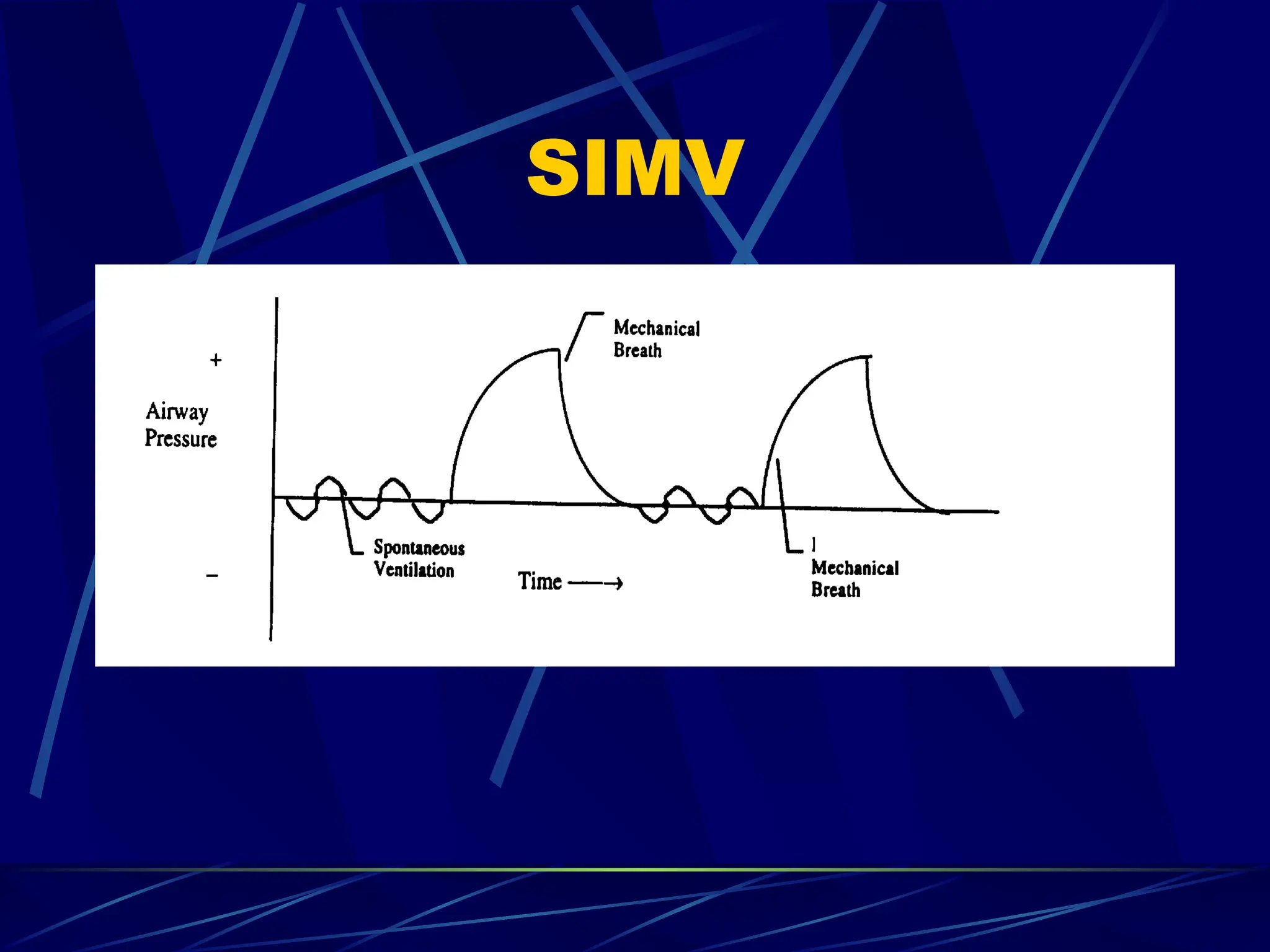 SIMV
 