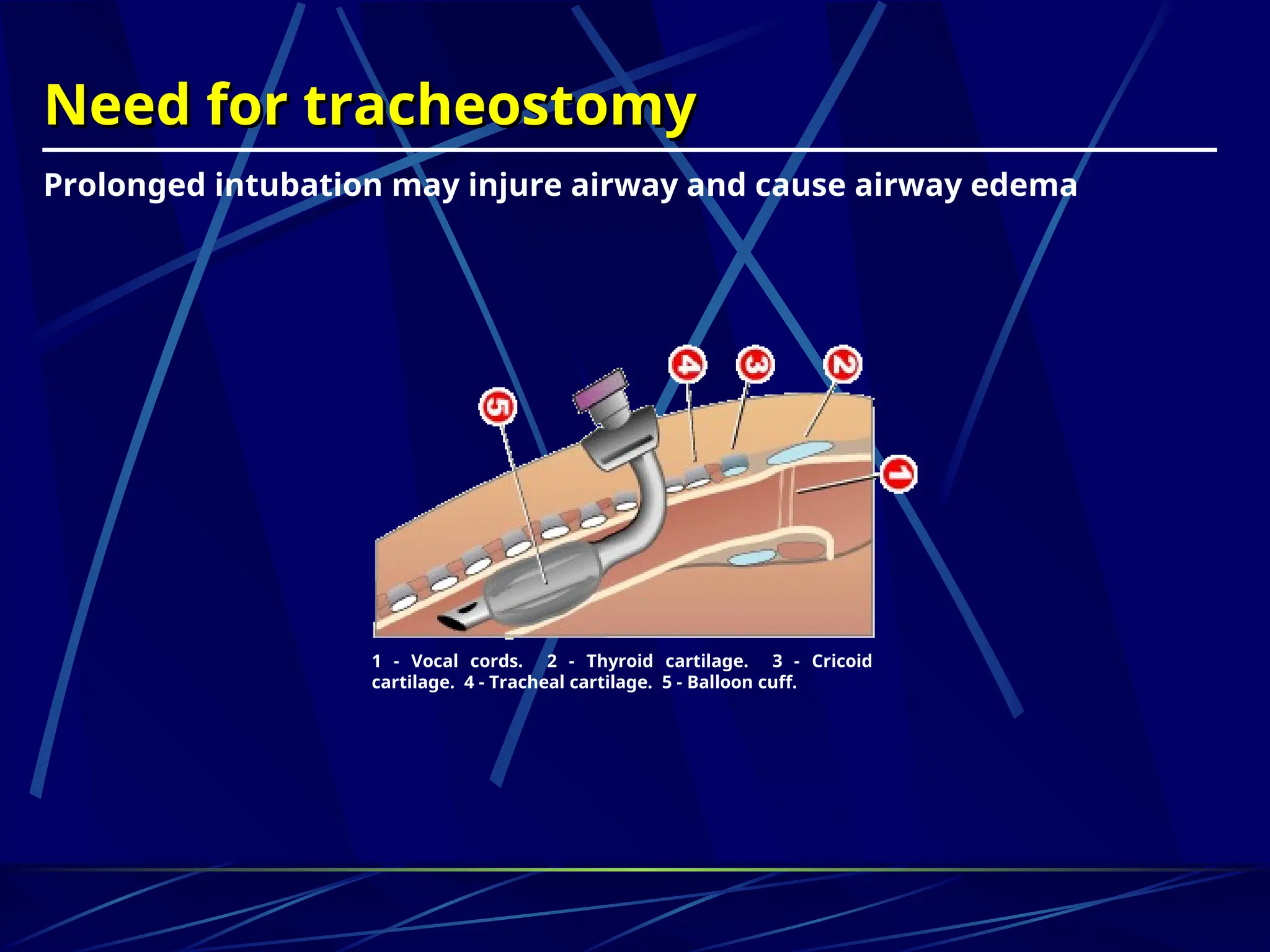 Need for tracheostomy
Need for tracheostomy
Prolonged intubation may injure airway and cause airway edema
1 - Vocal cords. 2 - Thyroid cartilage. 3 - Cricoid
cartilage. 4 - Tracheal cartilage. 5 - Balloon cuff.
 