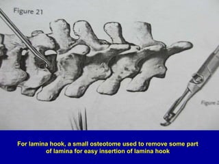For lamina hook, a small osteotome used to remove some part
of lamina for easy insertion of lamina hook
 