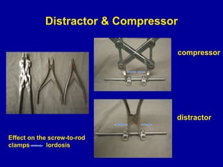 Distractor & Compressor
compressor
distractor
Effect on the screw-to-rod
clamps --- lordosis
 