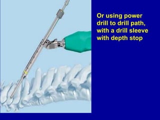 Or using power
drill to drill path,
with a drill sleeve
with depth stop
 