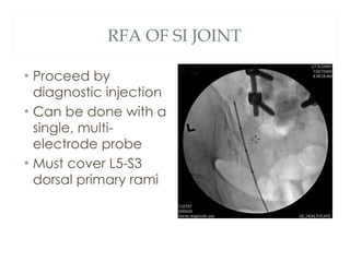 Basic spine injections | PPT
