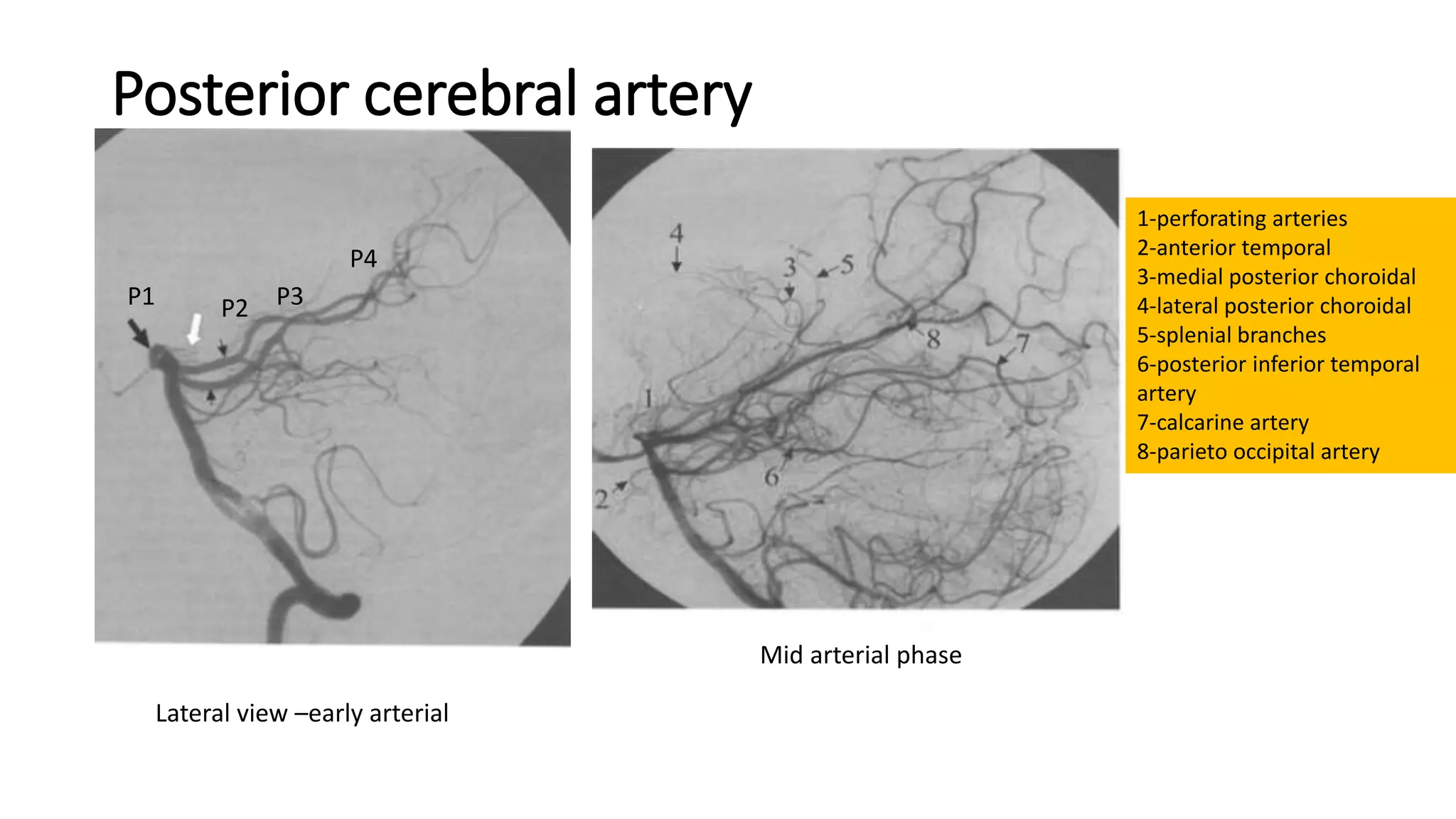 Posterior cerebral artery
Lateral view –early arterial
1-perforating arteries
2-anterior temporal
3-medial posterior choroidal
4-lateral posterior choroidal
5-splenial branches
6-posterior inferior temporal
artery
7-calcarine artery
8-parieto occipital artery
Mid arterial phase
P1 P2 P3
P4
 