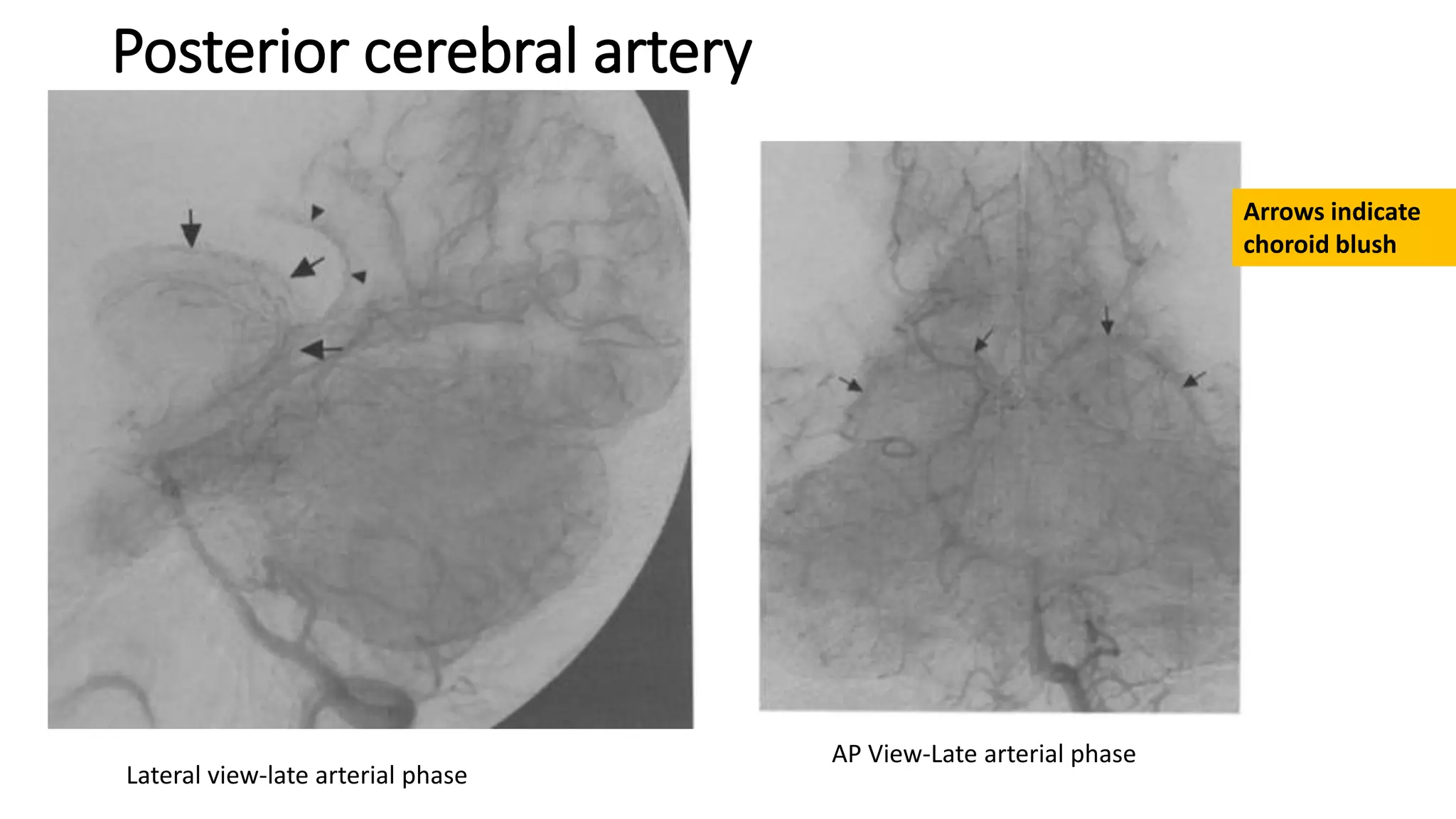 Posterior cerebral artery
Lateral view-late arterial phase
AP View-Late arterial phase
Arrows indicate
choroid blush
 
