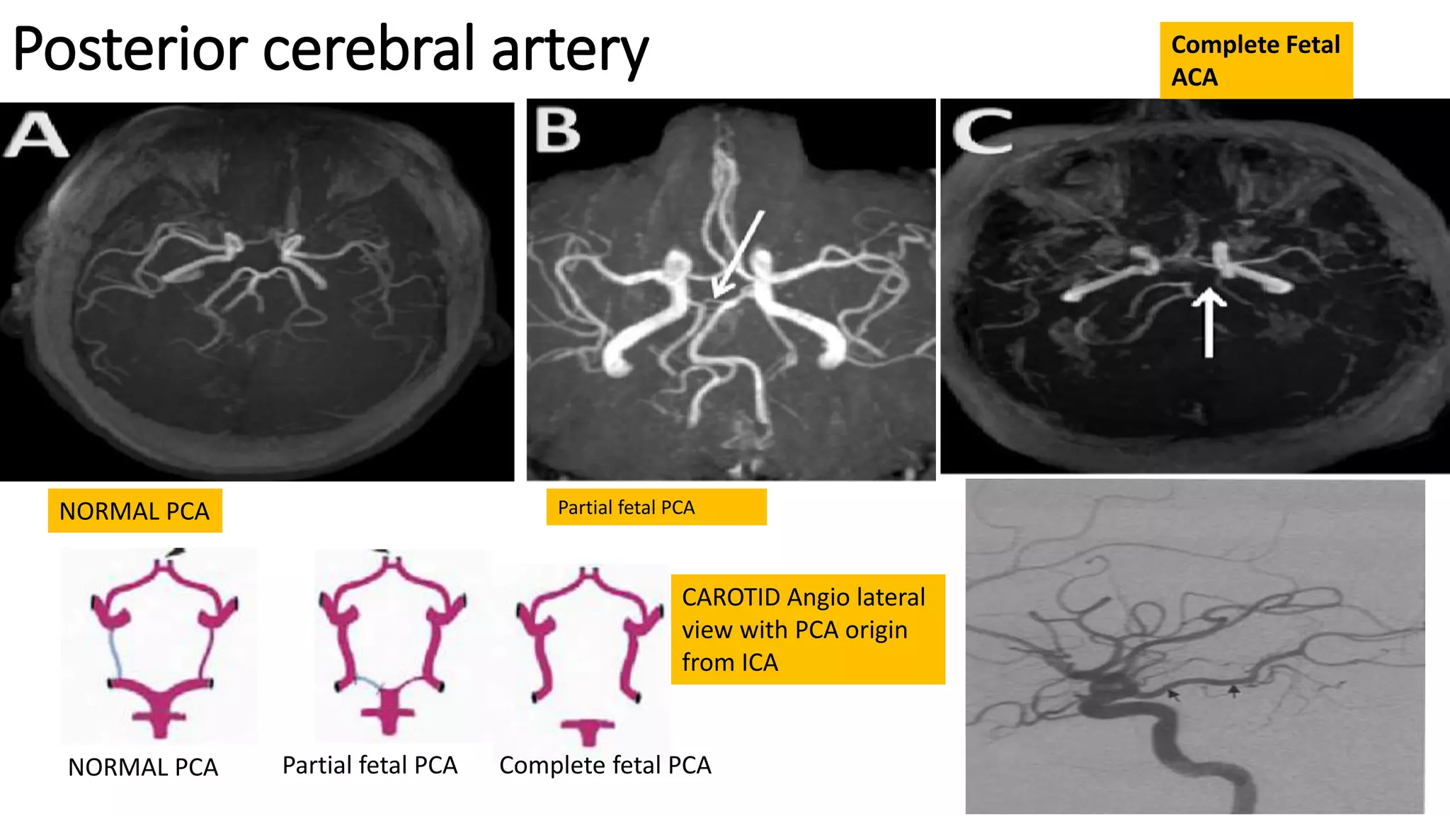 Posterior cerebral artery
NORMAL PCA Partial fetal PCA
Complete Fetal
ACA
CAROTID Angio lateral
view with PCA origin
from ICA
Partial fetal PCA Complete fetal PCANORMAL PCA
 