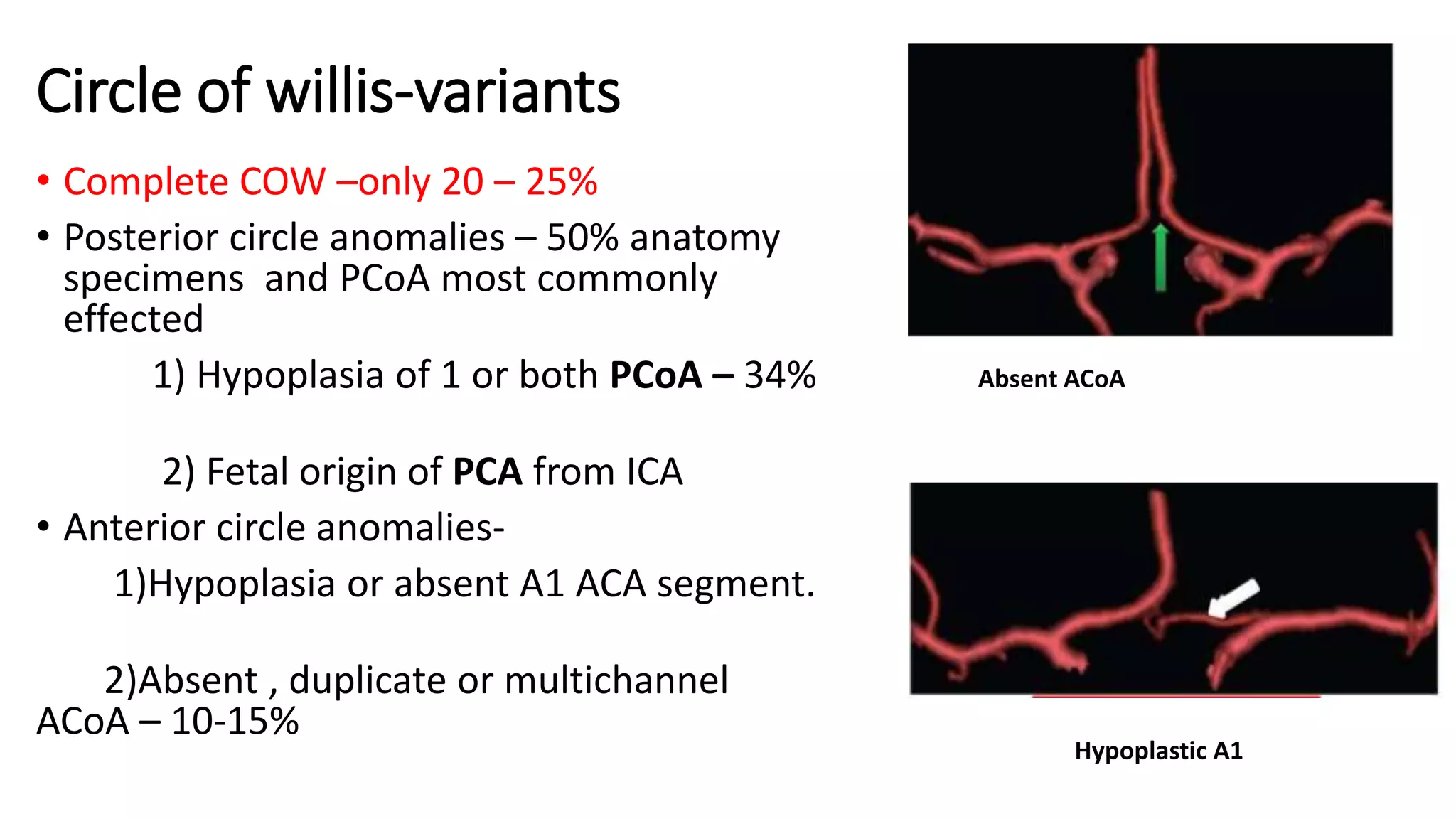 Circle of willis-variants
• Complete COW –only 20 – 25%
• Posterior circle anomalies – 50% anatomy
specimens and PCoA most commonly
effected
1) Hypoplasia of 1 or both PCoA – 34%
2) Fetal origin of PCA from ICA
• Anterior circle anomalies-
1)Hypoplasia or absent A1 ACA segment.
2)Absent , duplicate or multichannel
ACoA – 10-15%
Absent ACoA
Hypoplastic A1
 