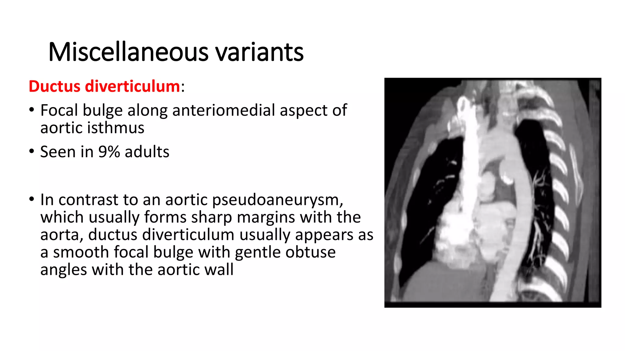 Miscellaneous variants
Ductus diverticulum:
• Focal bulge along anteriomedial aspect of
aortic isthmus
• Seen in 9% adults
• In contrast to an aortic pseudoaneurysm,
which usually forms sharp margins with the
aorta, ductus diverticulum usually appears as
a smooth focal bulge with gentle obtuse
angles with the aortic wall
 