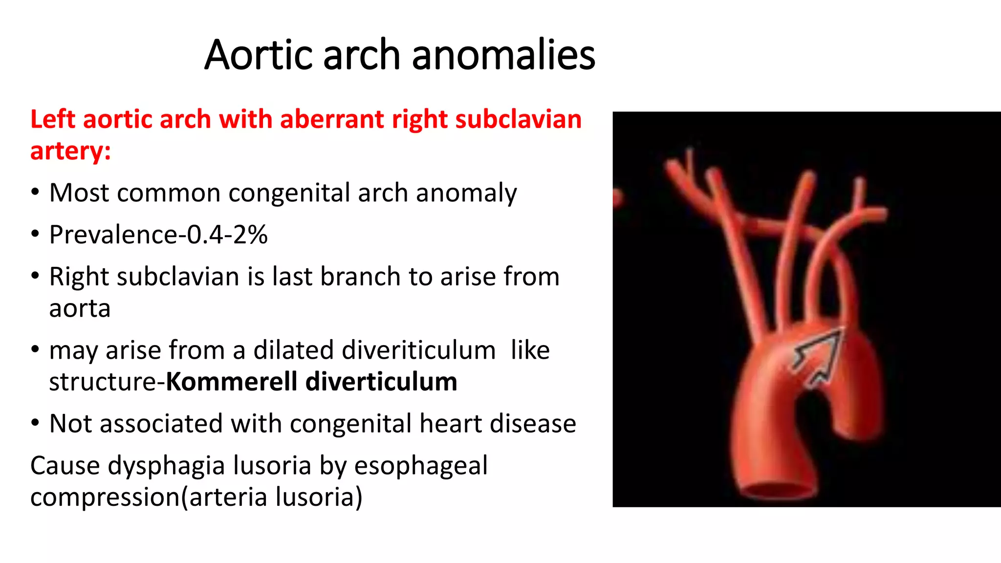Aortic arch anomalies
Left aortic arch with aberrant right subclavian
artery:
• Most common congenital arch anomaly
• Prevalence-0.4-2%
• Right subclavian is last branch to arise from
aorta
• may arise from a dilated diveriticulum like
structure-Kommerell diverticulum
• Not associated with congenital heart disease
Cause dysphagia lusoria by esophageal
compression(arteria lusoria)
 