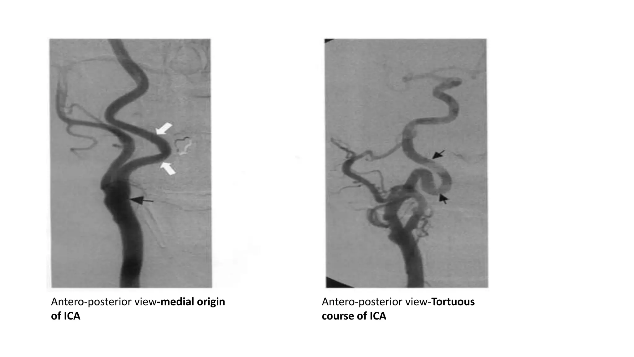 Antero-posterior view-medial origin
of ICA
Antero-posterior view-Tortuous
course of ICA
 