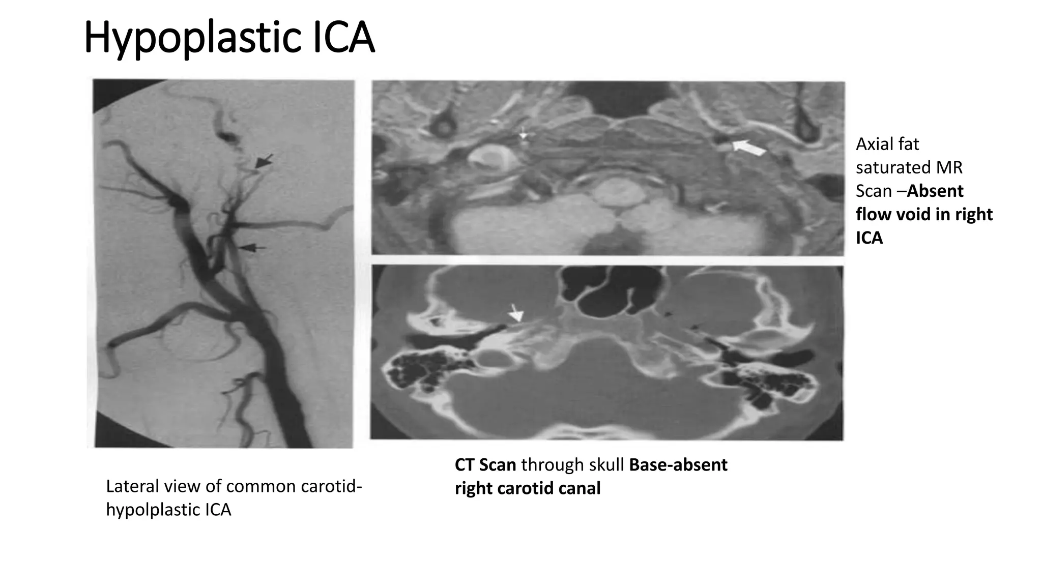 Hypoplastic ICA
Lateral view of common carotid-
hypolplastic ICA
Axial fat
saturated MR
Scan –Absent
flow void in right
ICA
CT Scan through skull Base-absent
right carotid canal
 