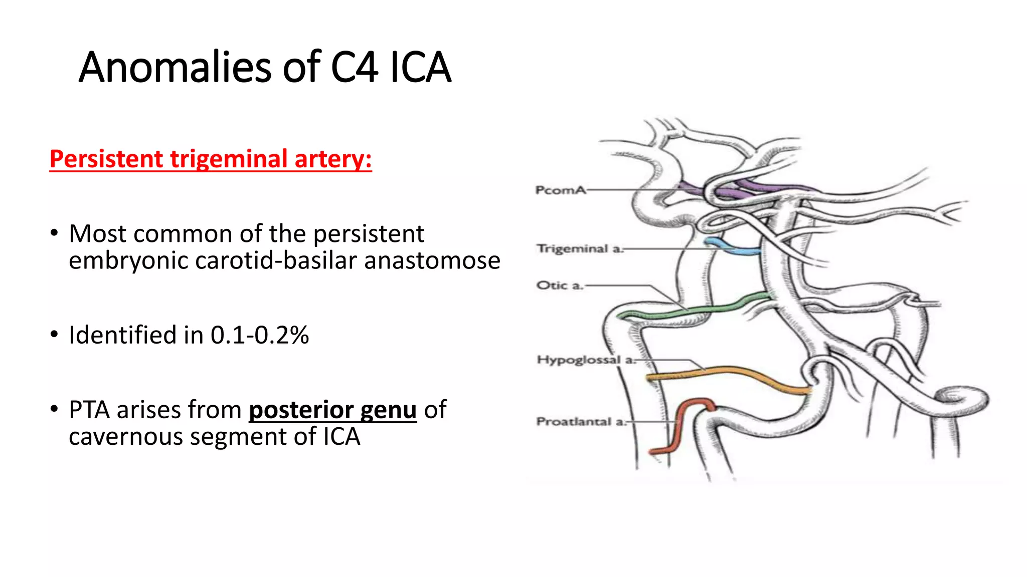 Anomalies of C4 ICA
Persistent trigeminal artery:
• Most common of the persistent
embryonic carotid-basilar anastomose
• Identified in 0.1-0.2%
• PTA arises from posterior genu of
cavernous segment of ICA
 