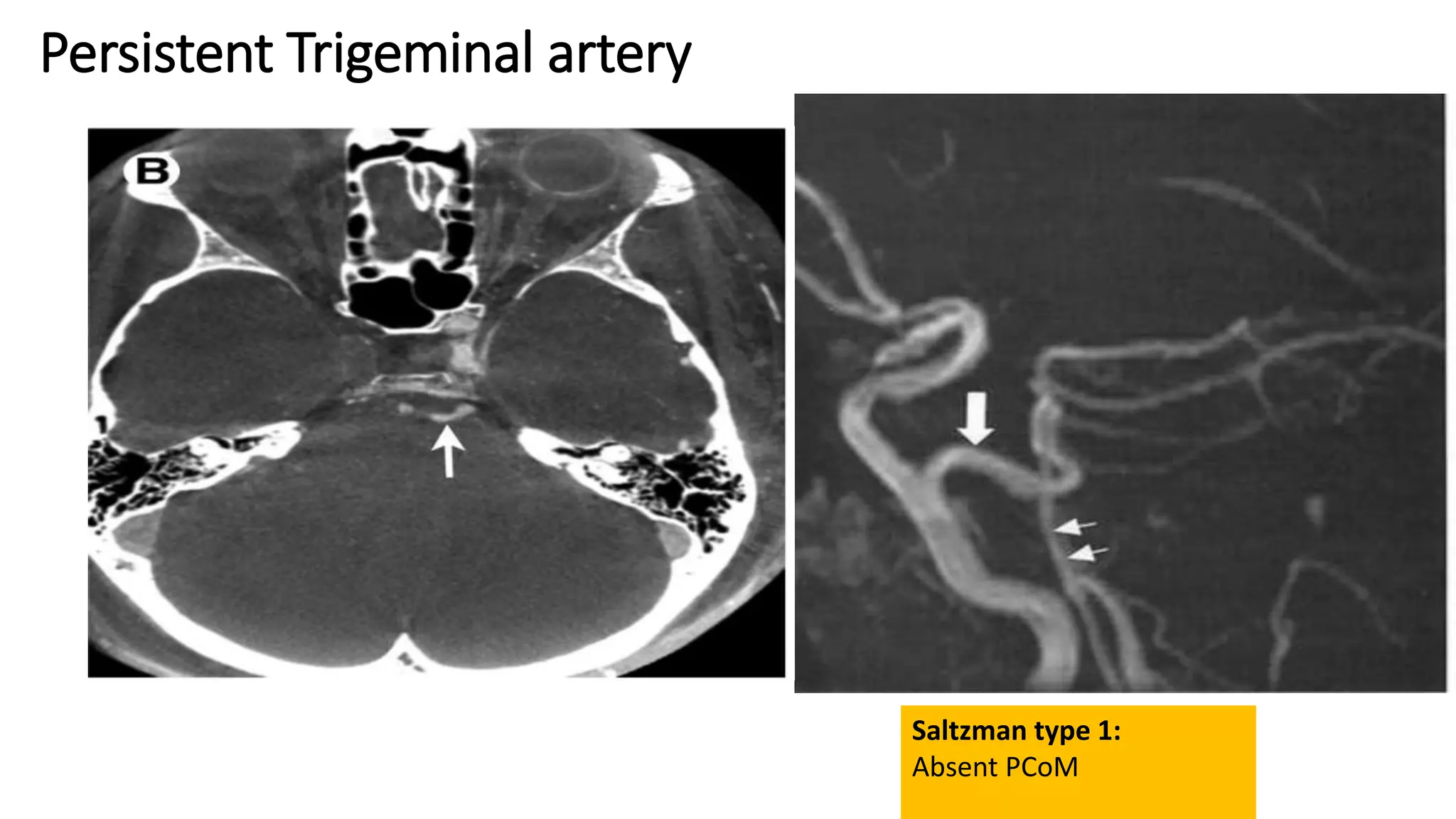 Persistent Trigeminal artery
Saltzman type 1:
Absent PCoM
 