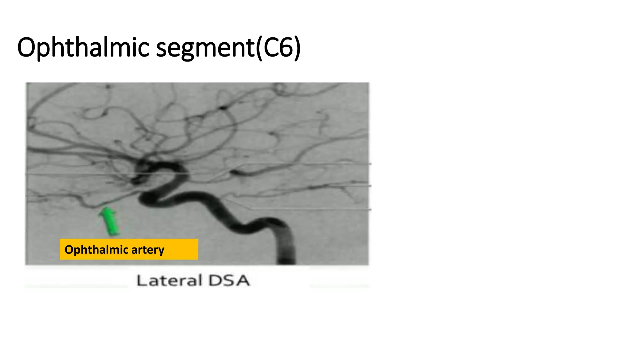 Ophthalmic segment(C6)
Ophthalmic artery
 
