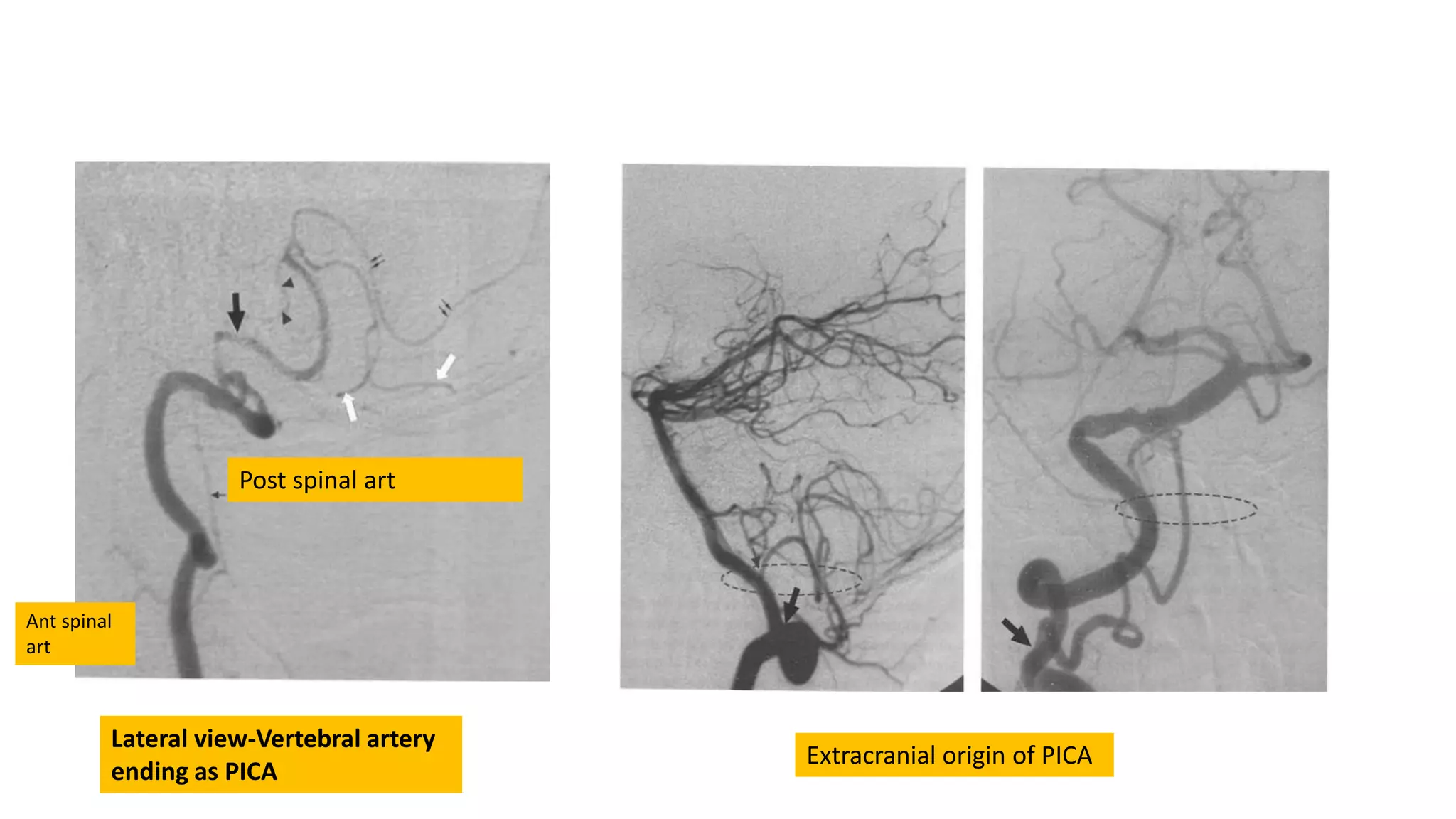 Lateral view-Vertebral artery
ending as PICA
Ant spinal
art
Post spinal art
Extracranial origin of PICA
 