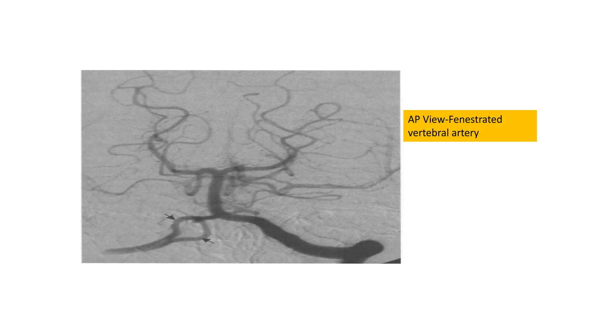 AP View-Fenestrated
vertebral artery
 