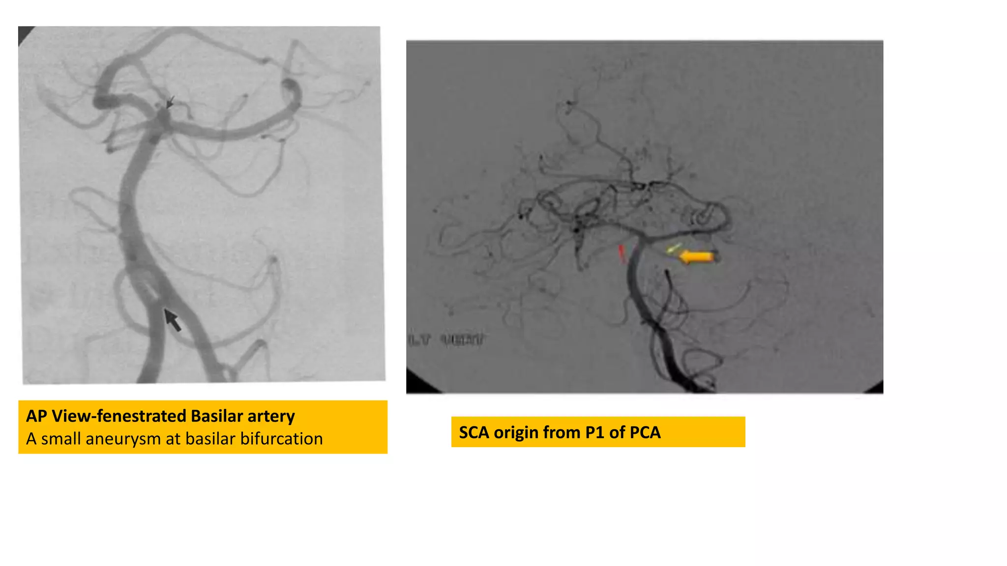 AP View-fenestrated Basilar artery
A small aneurysm at basilar bifurcation SCA origin from P1 of PCA
 