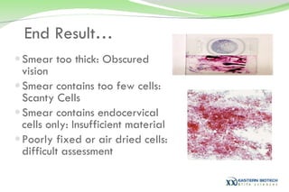 End Result… Smear too thick: Obscured vision Smear contains too few cells: Scanty Cells Smear contains endocervical cells only: Insufficient material Poorly fixed or air dried cells: difficult assessment  