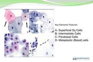 Key Elements/ Features: A- Superficial Sq Cells B- Intermediate Cells C- Parabasal Cells D- Metaplastic (Basal) cells 