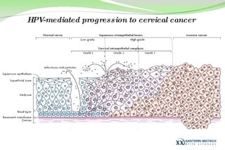 HPV-mediated progression to cervical cancer   