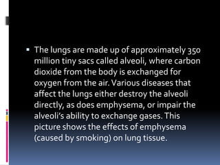 The lungs are made up of approximately 350 million tiny sacs called alveoli, where carbon dioxide from the body is exchanged for oxygen from the air. Various diseases that affect the lungs either destroy the alveoli directly, as does emphysema, or impair the alveoli’s ability to exchange gases. This picture shows the effects of emphysema (caused by smoking) on lung tissue.