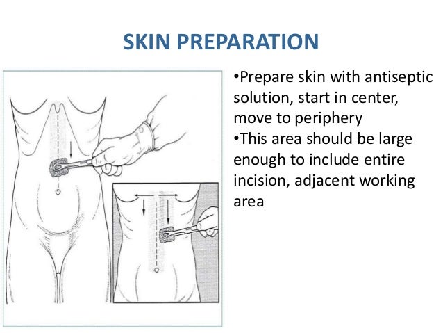 prep technique