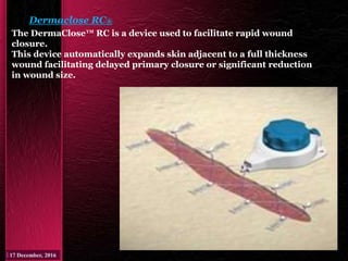 Dermaclose RC®
The DermaClose™ RC is a device used to facilitate rapid wound
closure.
This device automatically expands skin adjacent to a full thickness
wound facilitating delayed primary closure or significant reduction
in wound size.
 
