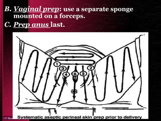B. Vaginal prep: use a separate sponge
mounted on a forceps.
C. Prep anus last.
 