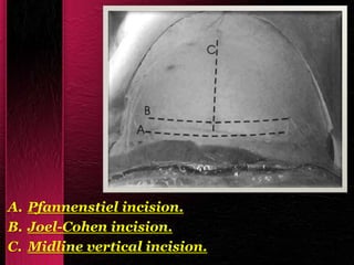 A. Pfannenstiel incision.
B. Joel-Cohen incision.
C. Midline vertical incision.
 