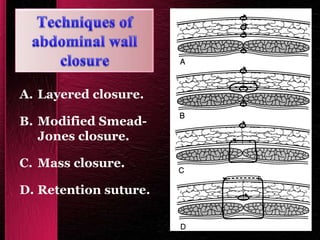 A. Layered closure.
B. Modified Smead-
Jones closure.
C. Mass closure.
D. Retention suture.
 