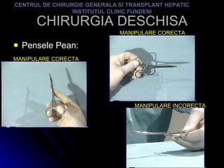 CHIRURGIA DESCHISA Pensele Pean: CENTRUL DE CHIRURGIE GENERALA SI TRANSPLANT HEPATIC  INSTITUTUL CLINIC FUNDENI MANIPULARE CORECTA MANIPULARE CORECTA STG. MANIPULARE CORECTA MANIPULARE INCORECTA 