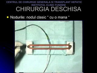 CHIRURGIA DESCHISA Nodurile: nodul clasic “ cu o mana “ CENTRUL DE CHIRURGIE GENERALA SI TRANSPLANT HEPATIC  INSTITUTUL CLINIC FUNDENI 