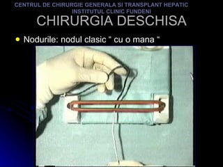 CHIRURGIA DESCHISA Nodurile: nodul clasic “ cu o mana “ CENTRUL DE CHIRURGIE GENERALA SI TRANSPLANT HEPATIC  INSTITUTUL CLINIC FUNDENI 