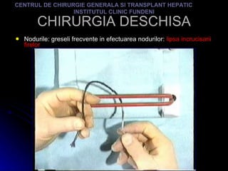 CHIRURGIA DESCHISA Nodurile: greseli frecvente in efectuarea nodurilor:  lipsa incrucisarii firelor CENTRUL DE CHIRURGIE GENERALA SI TRANSPLANT HEPATIC  INSTITUTUL CLINIC FUNDENI 
